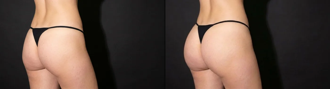 Antes e depois de preenchimento glúteo em Brasília — Dr. Thiago Perfeito