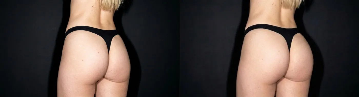 Antes e depois de preenchimento glúteo em Brasília — Dr. Thiago Perfeito