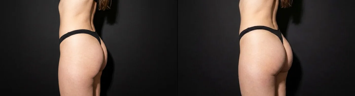 Antes e depois de preenchimento glúteo em Brasília — Dr. Thiago Perfeito