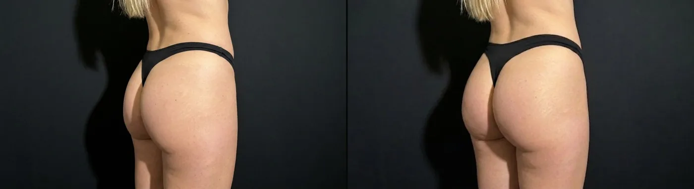 Antes e depois de preenchimento glúteo em Brasília — Dr. Thiago Perfeito