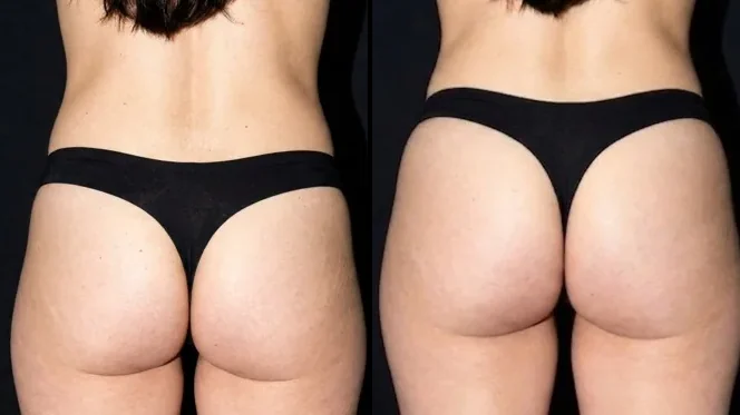 Butt filler before and after in Brasília — Dr. Thiago Perfeito (case 1)