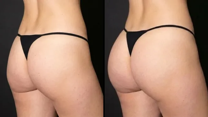 Butt filler before and after in Brasília — Dr. Thiago Perfeito (case 3)