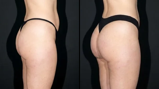 Butt filler before and after in Brasília — Dr. Thiago Perfeito (case 4)