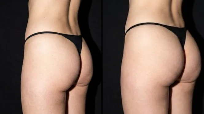 Butt filler before and after in Brasília — Dr. Thiago Perfeito (case 7)