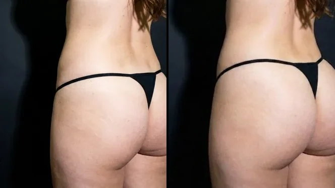 Butt filler before and after in Brasília — Dr. Thiago Perfeito (case 8)